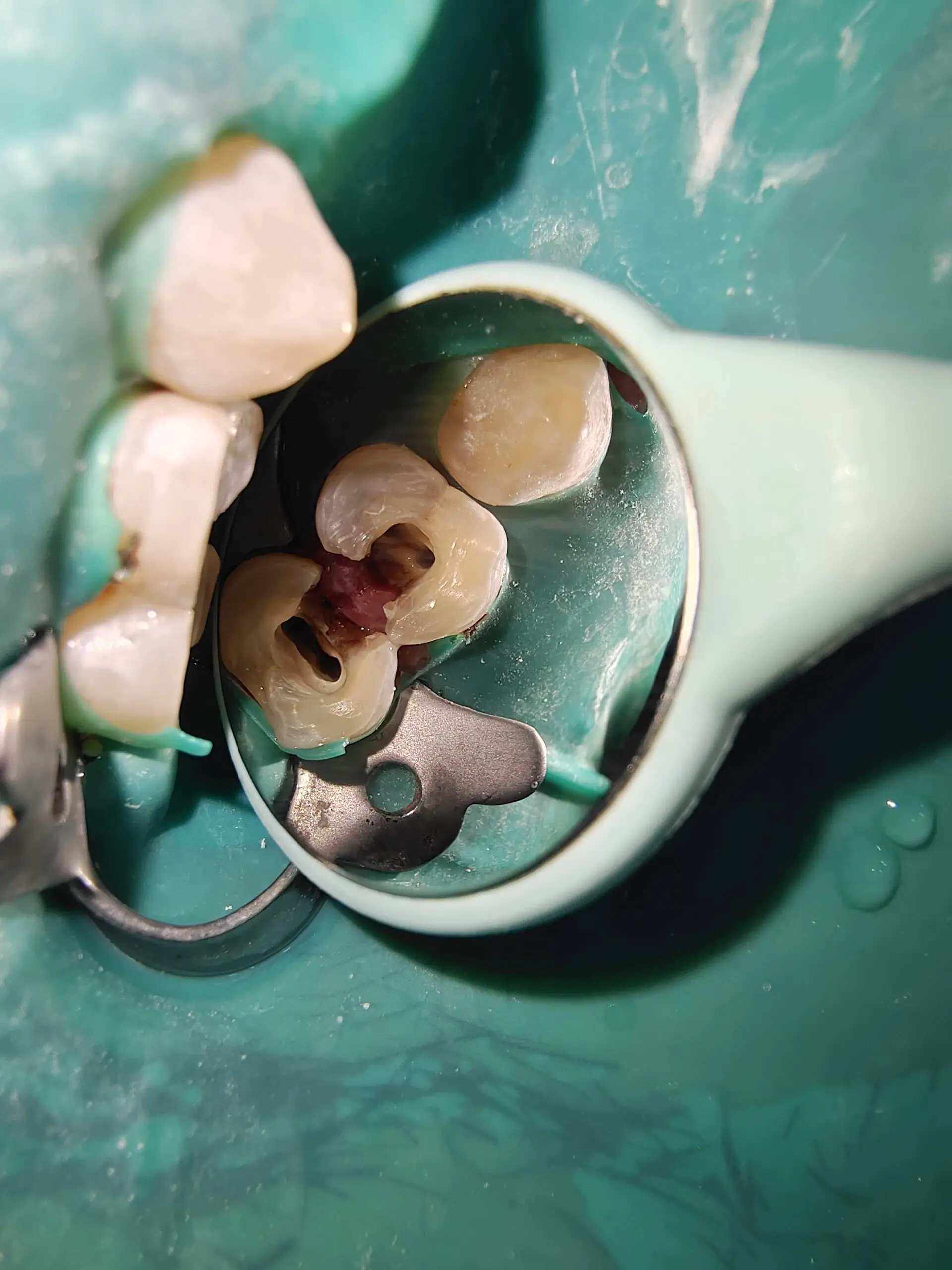 ROOT CANAL TREATMENT IN KOLKATA