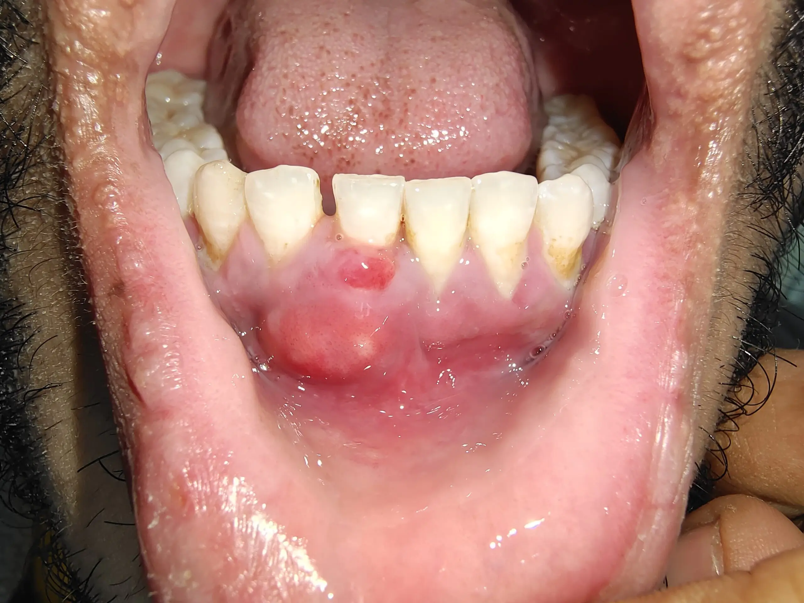 Signs You Need Root canal 3