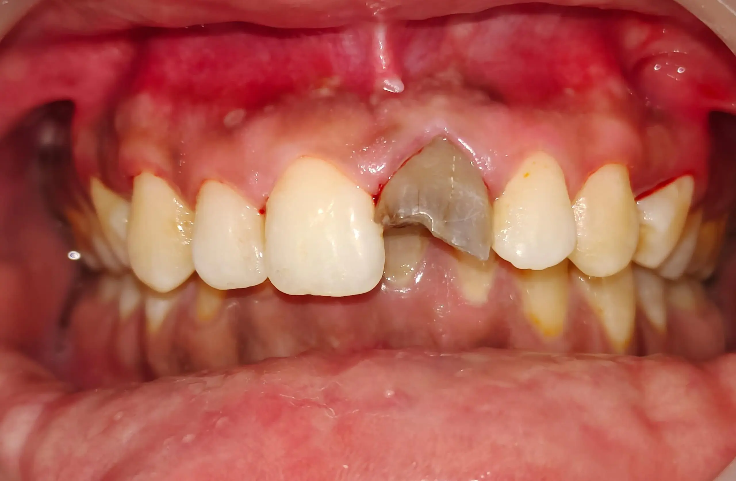Signs You Need Root canal 4