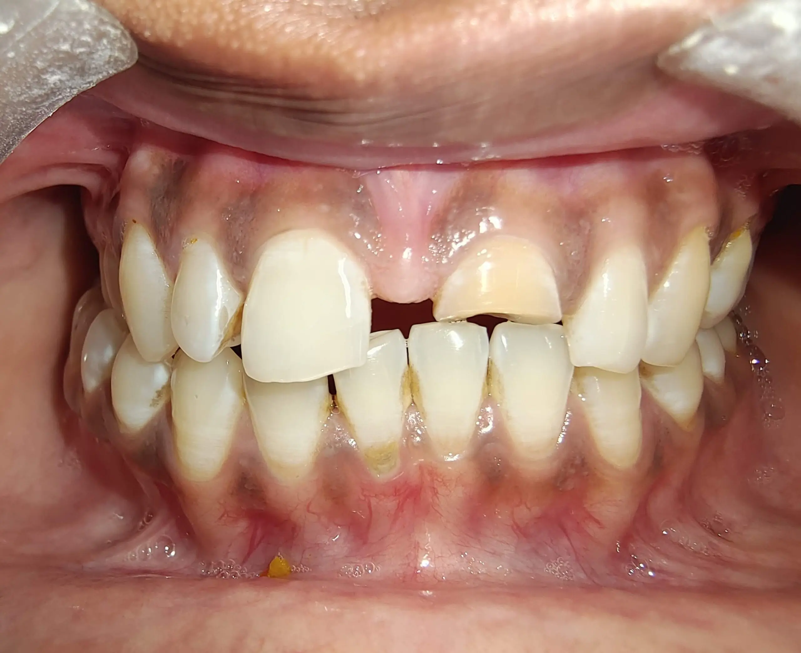 Signs You Need Root canal