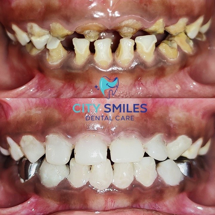 Pedo Full mouth square