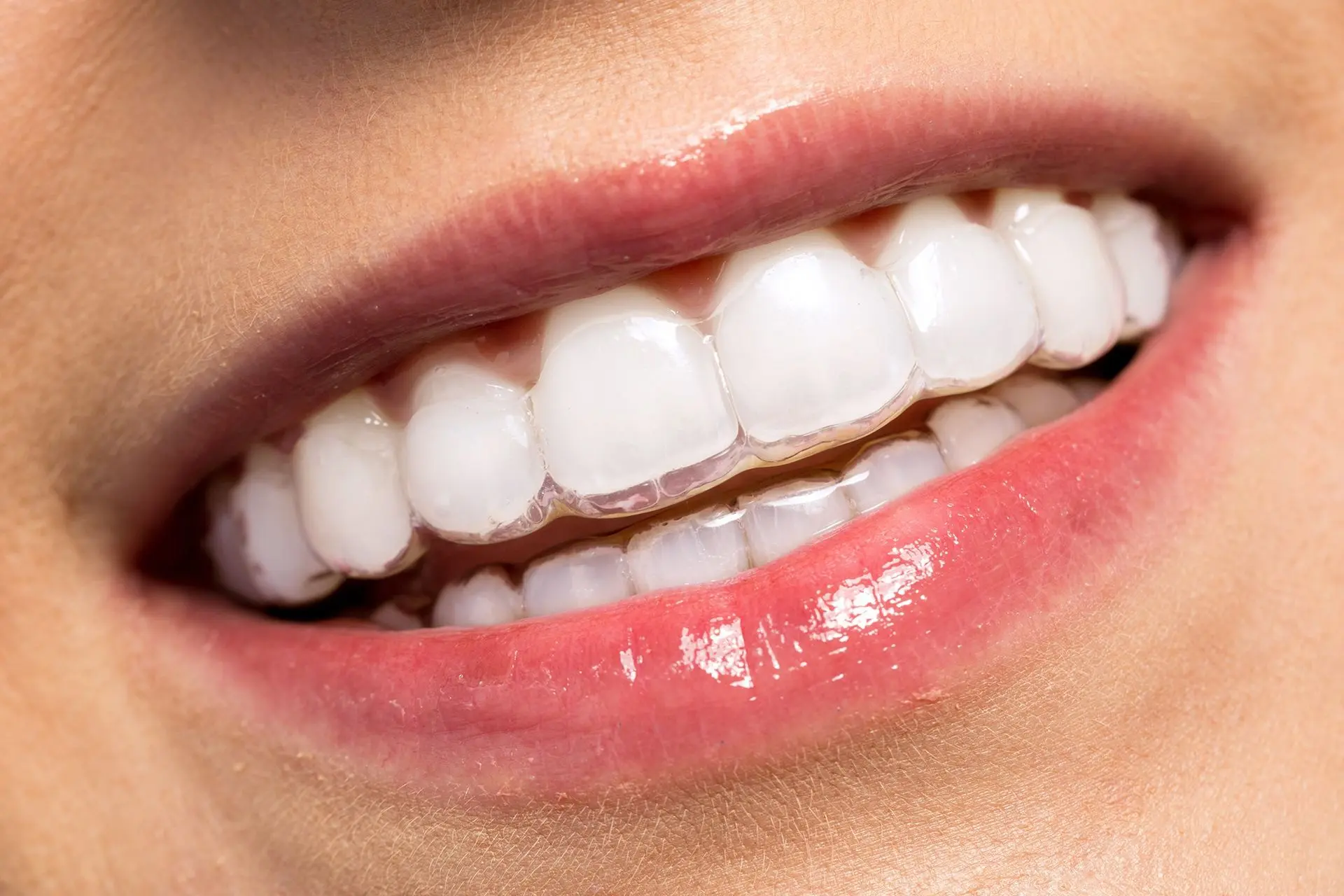 invisible braces in Kolkata