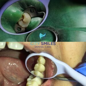 Root canal in City Smiles Dental Care