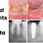 Restore Your Smile with Dental Implants in Kolkata