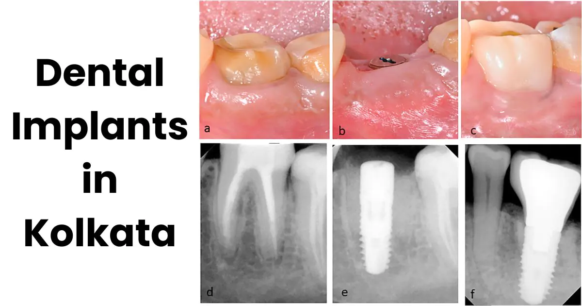 Dental Implants in Kolkata