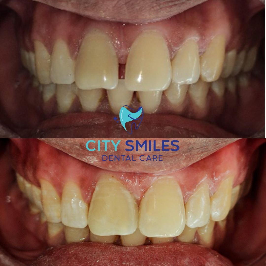 Teeth Gap