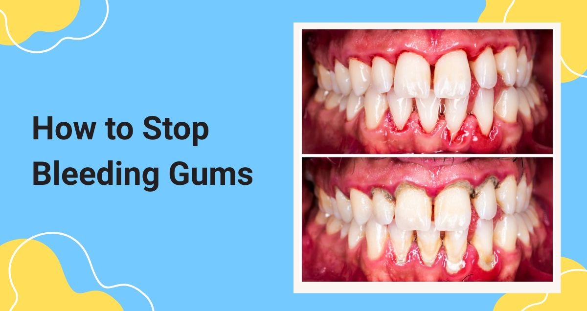 How to Stop Bleeding Gums