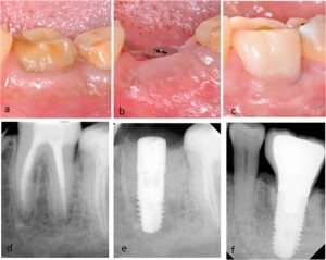Implant Molar