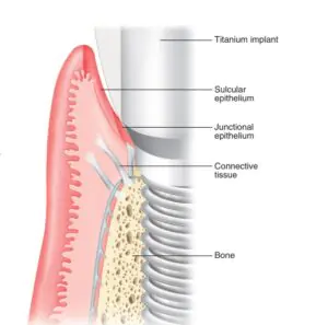 Parts of an implant