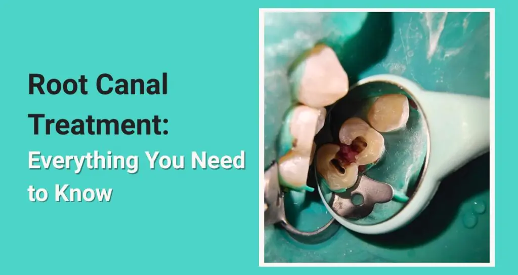Root Canal Treatment: Everything You Need to Know