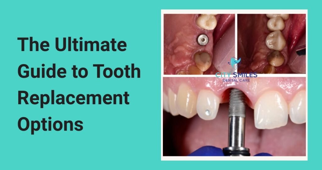 The Ultimate Guide to Tooth Replacement Options