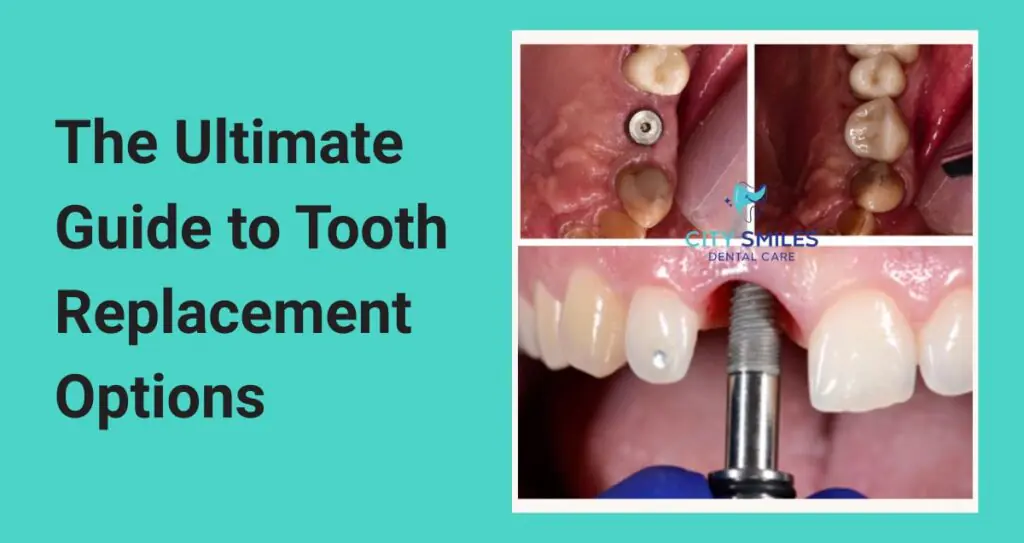 The Ultimate Guide to Tooth Replacement Options