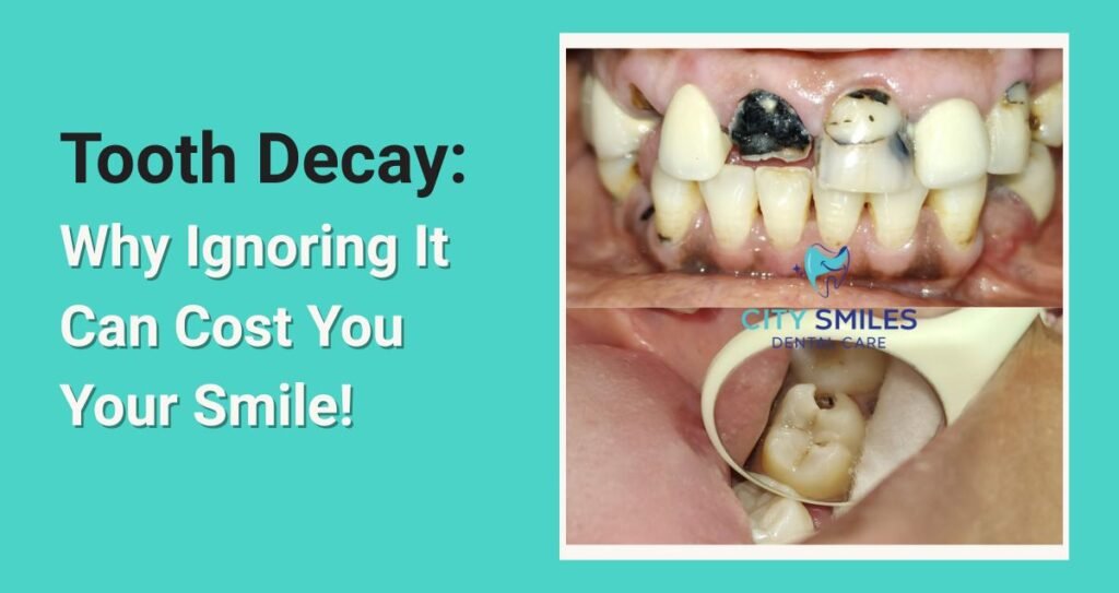 Tooth Decay: Why Ignoring It Can Cost You Your Smile!
