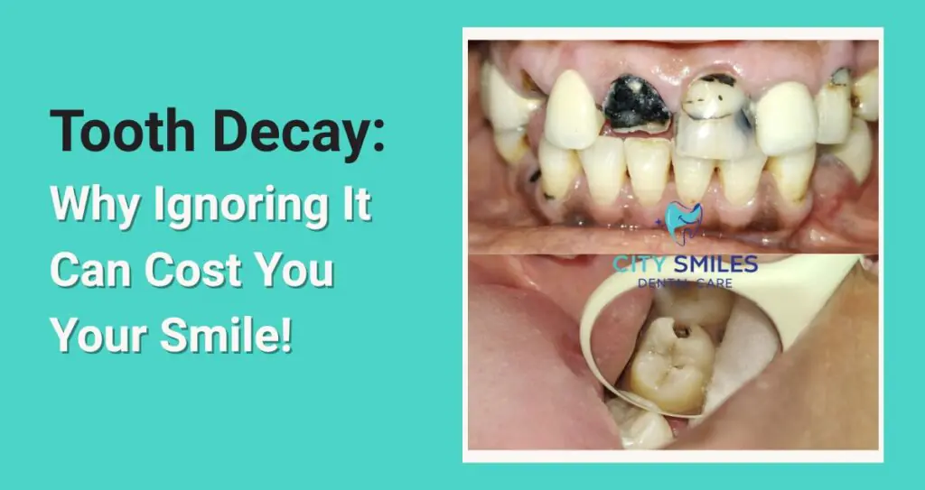 Tooth Decay: Why Ignoring It Can Cost You Your Smile!