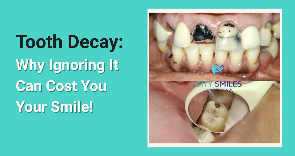 Tooth Decay: Why Ignoring It Can Cost You Your Smile!