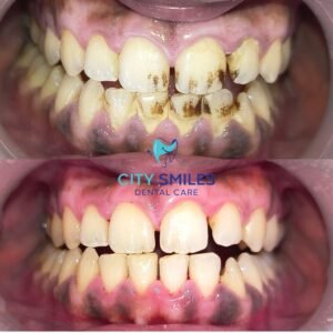 Teeth cleaning
