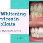 Teeth Whitening Services in Kolkata: Not the Same as Scaling!