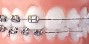 metal vs ceramic braces