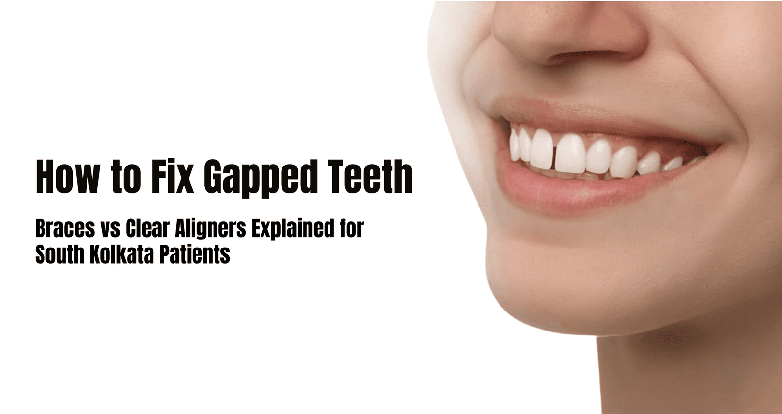 gapped teeth treatment in South Kolkata