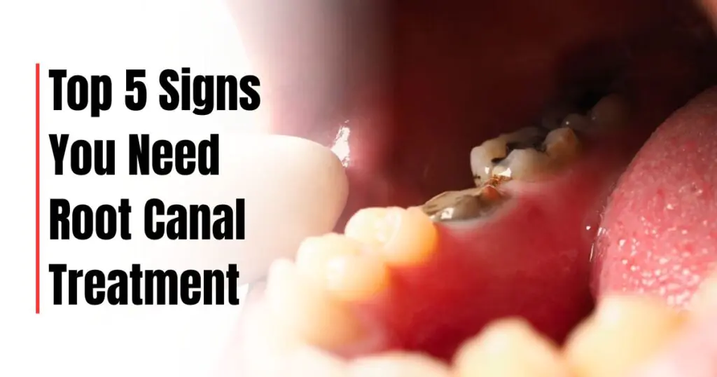 Root canal treatment in South Kolkata