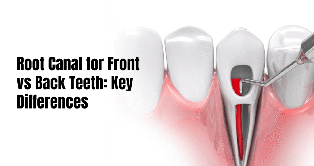 Root canal for front vs back teeth
