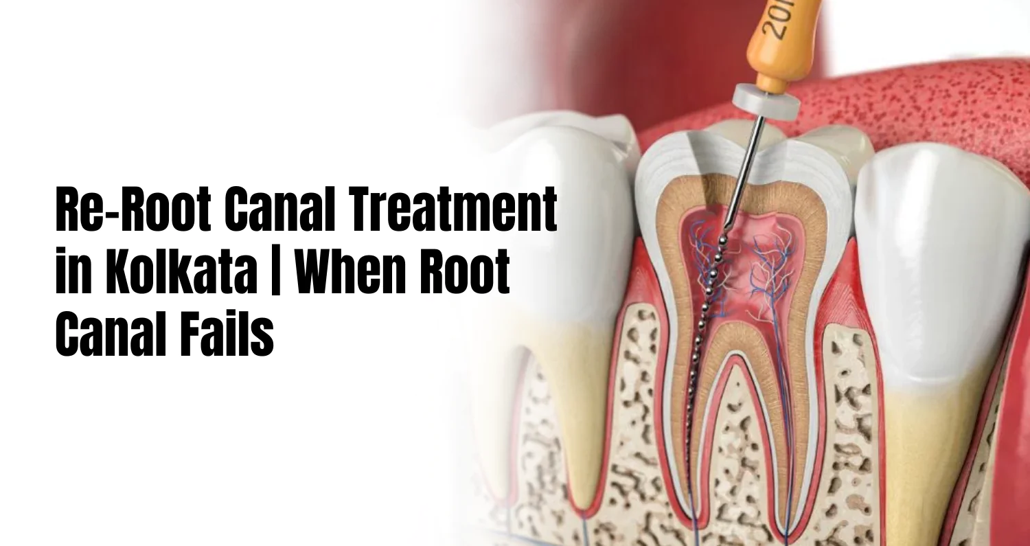 re root canal treatment