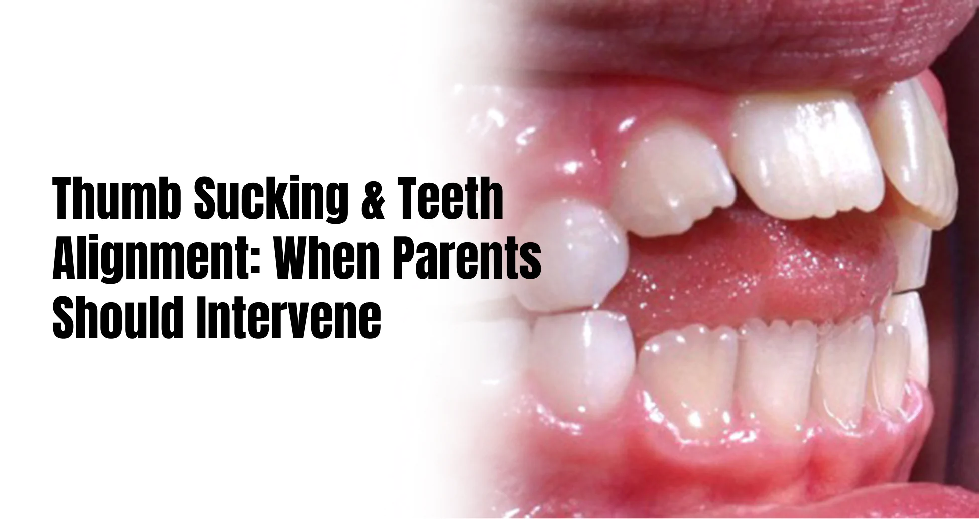 Thumb sucking and teeth alignment