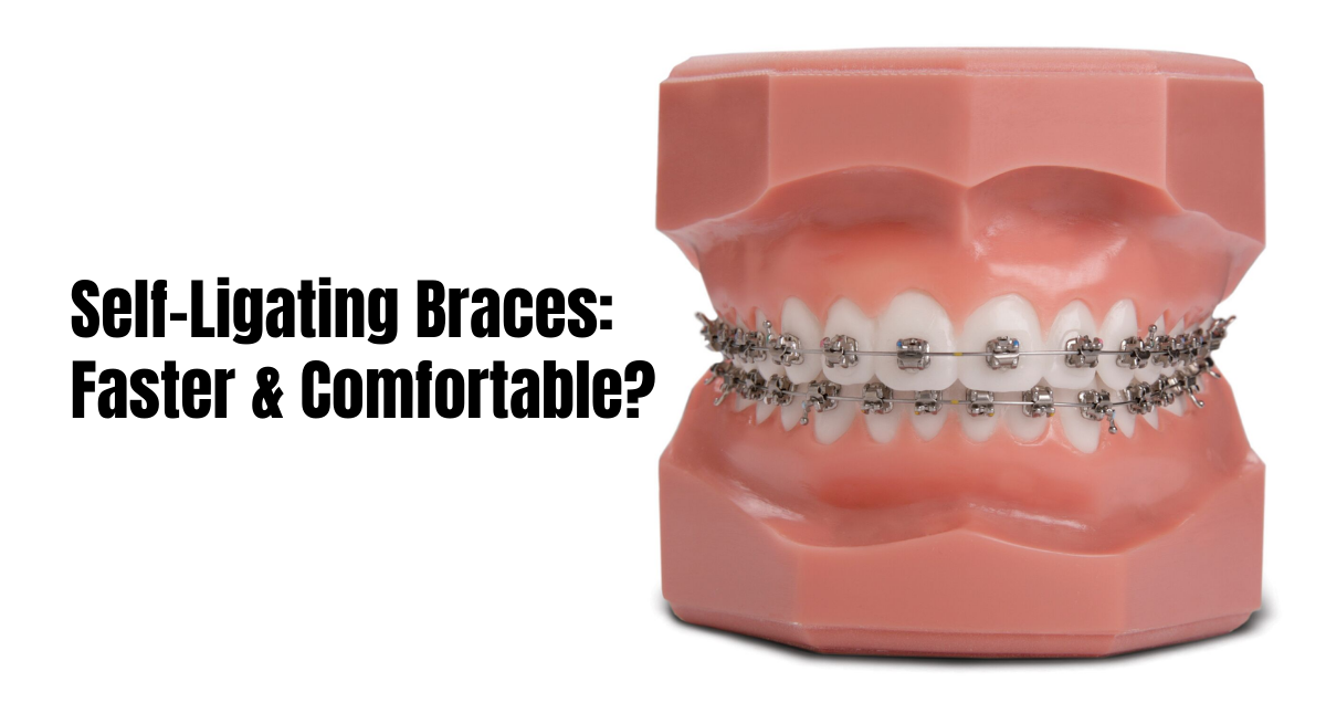 Self-ligating braces