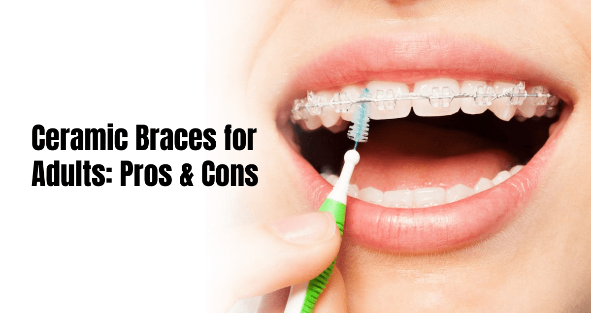 Ceramic braces for adults