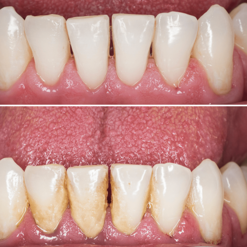gum treatment in Kolkata