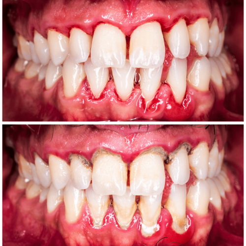 Side-by-side images of gums before and after treatment at City Smile Dental Care: the top image shows healthy gums with clean teeth, while the bottom image shows inflamed gums with visible tartar and bleeding, indicating gum disease.