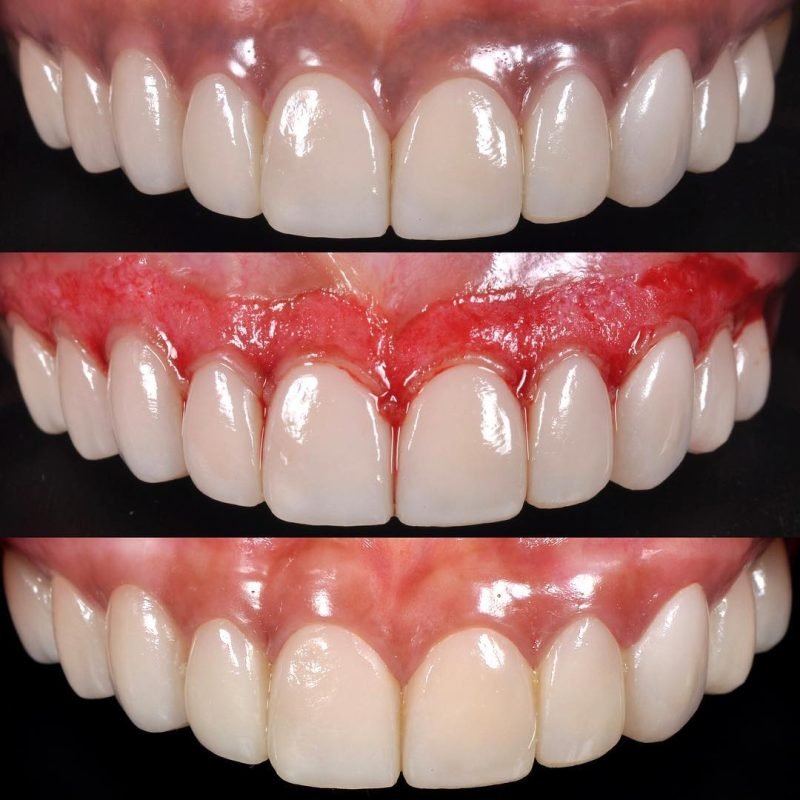 Copy of Gingival Depigmentation