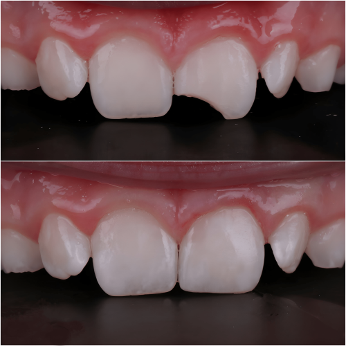 Dental Bonding Composite
