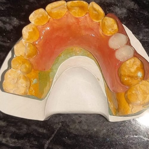 Denture Flexible (3)