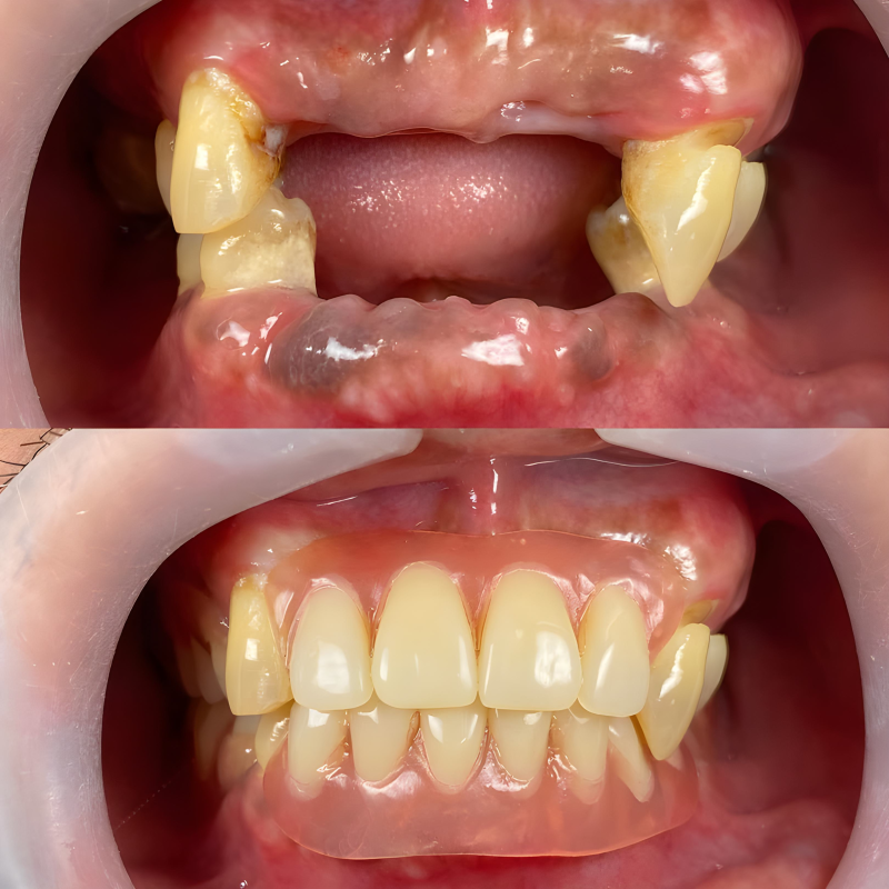 dentures in Kolkata