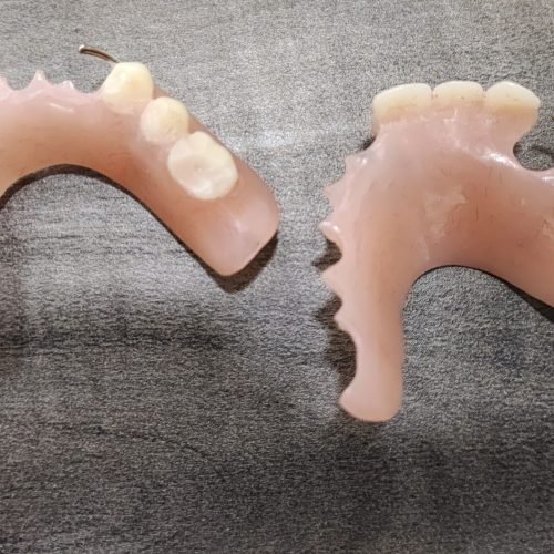 Denture Normal