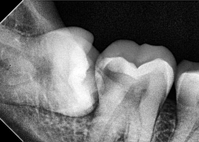 Horizontal Impaction