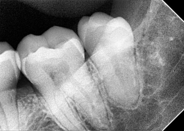 Impaction Distoangular