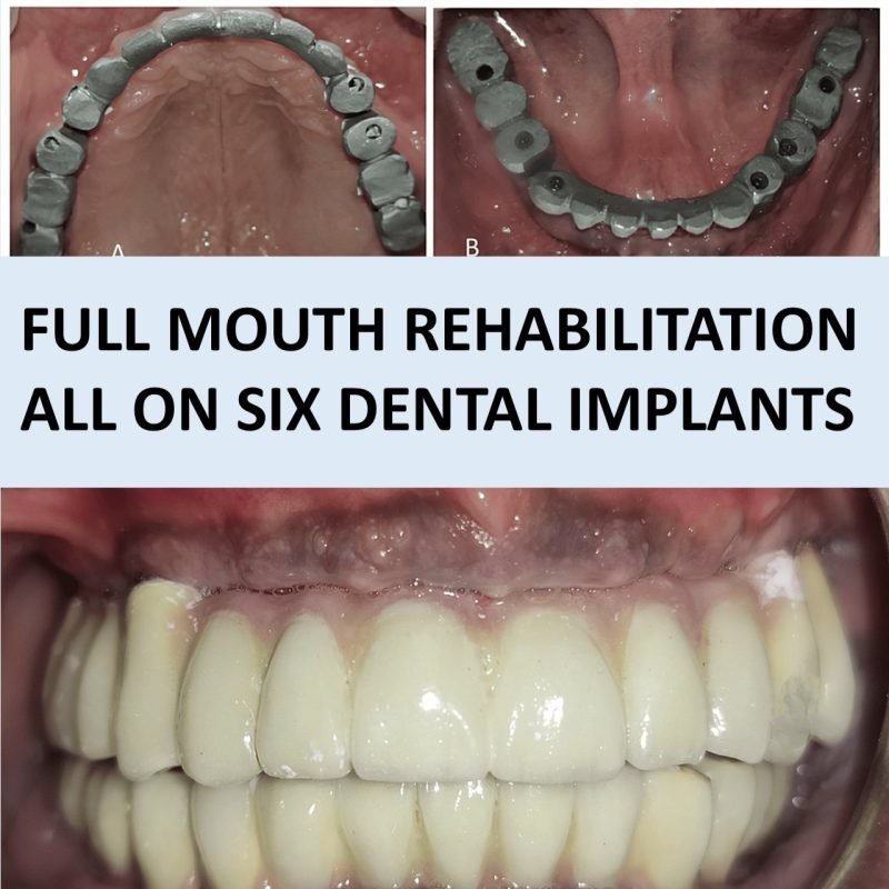 Implant Full mouth CD Sqaure