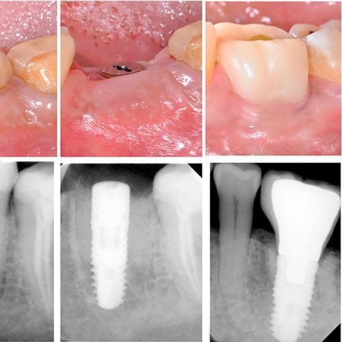 Implant Molar Square