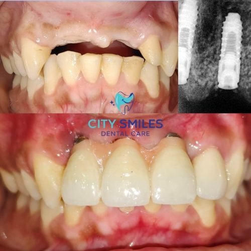 Implant Square