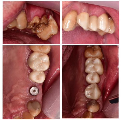 Implant with crown (1)