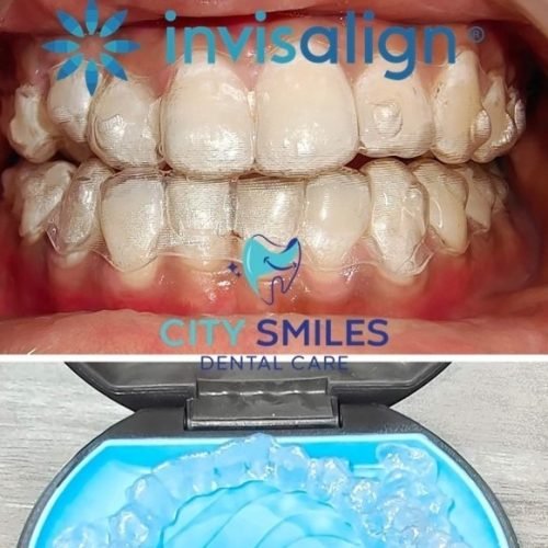 Invisalign Post (1)
