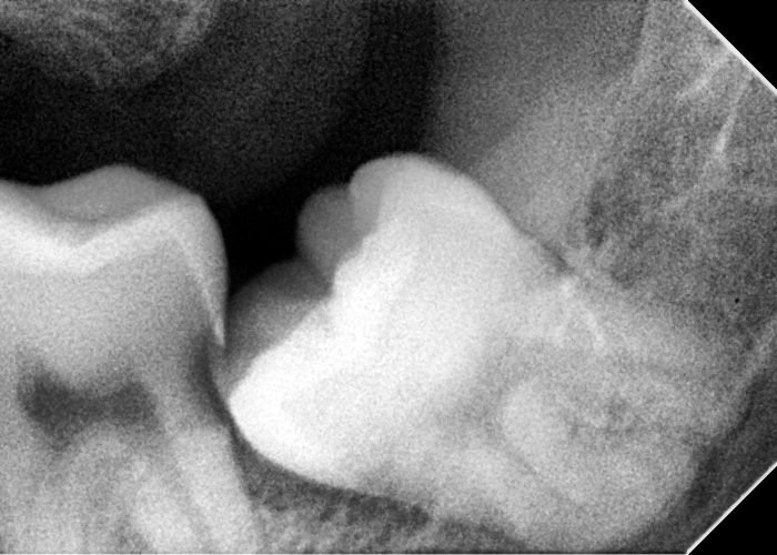 Mesioangular Impaction