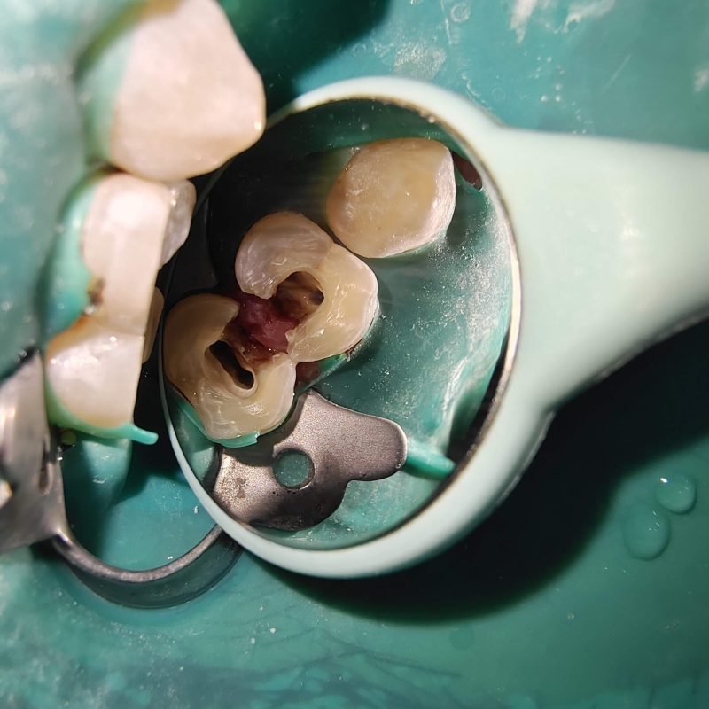 ROOT CANAL TREATMENT IN KOLKATA