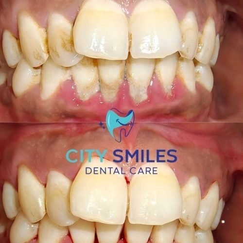 gum treatment in Kolkata