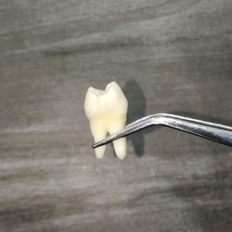wisdom tooth extraction in Kolkata